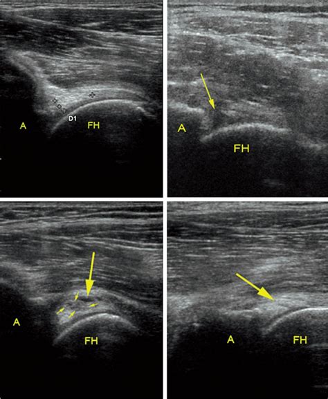 accuracy of acetabular labrum tear tests|acetabular labral tear ultrasound.